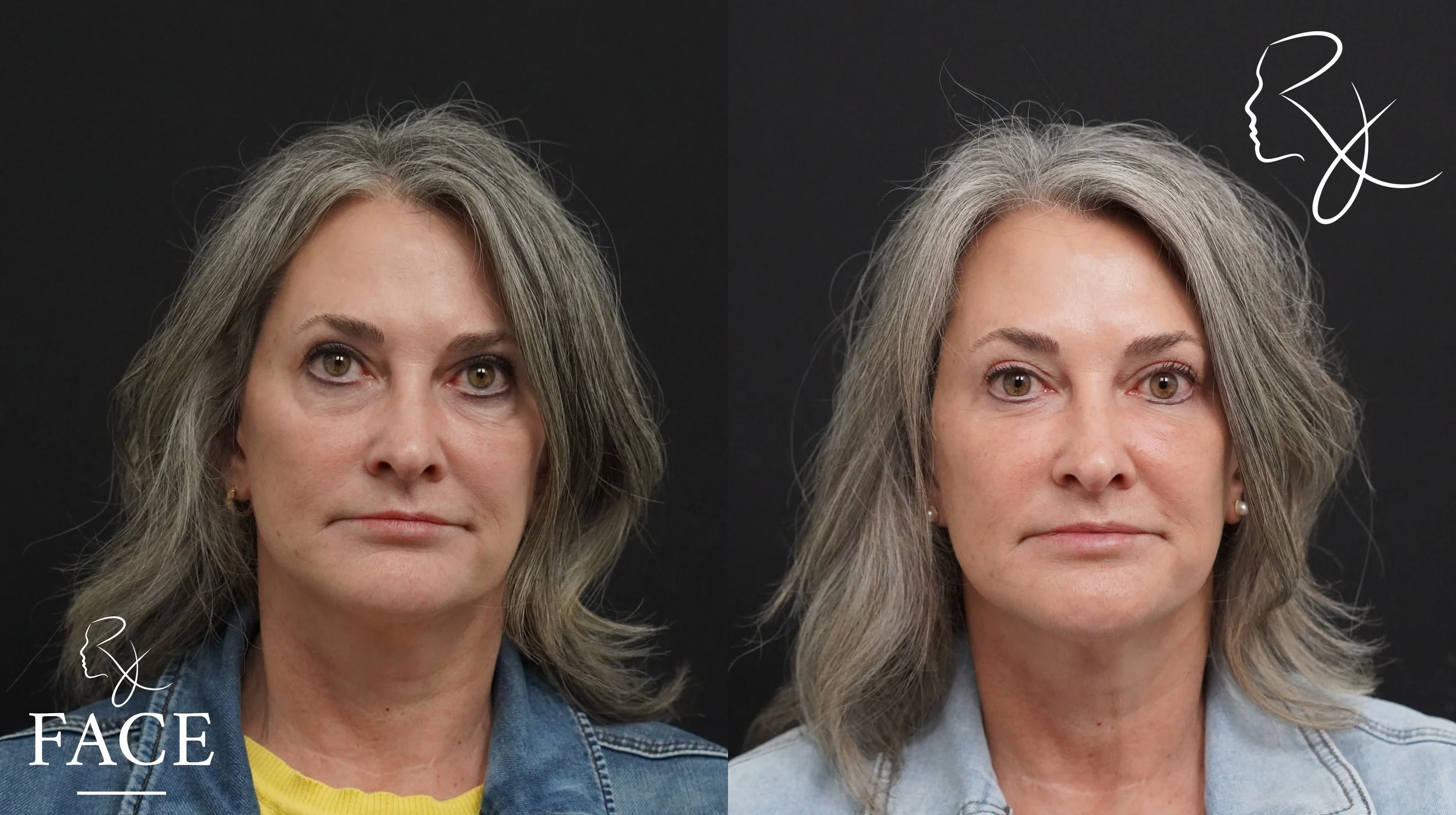 The outcome or results depicted are not 
guaranteed and may vary between patients.