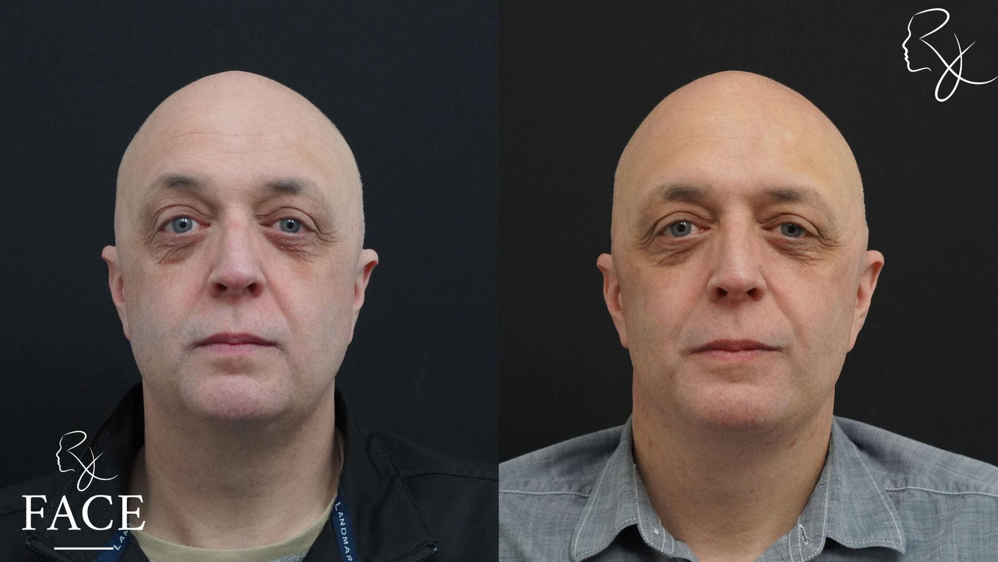The outcome or results depicted are not
guaranteed and may vary between patients.