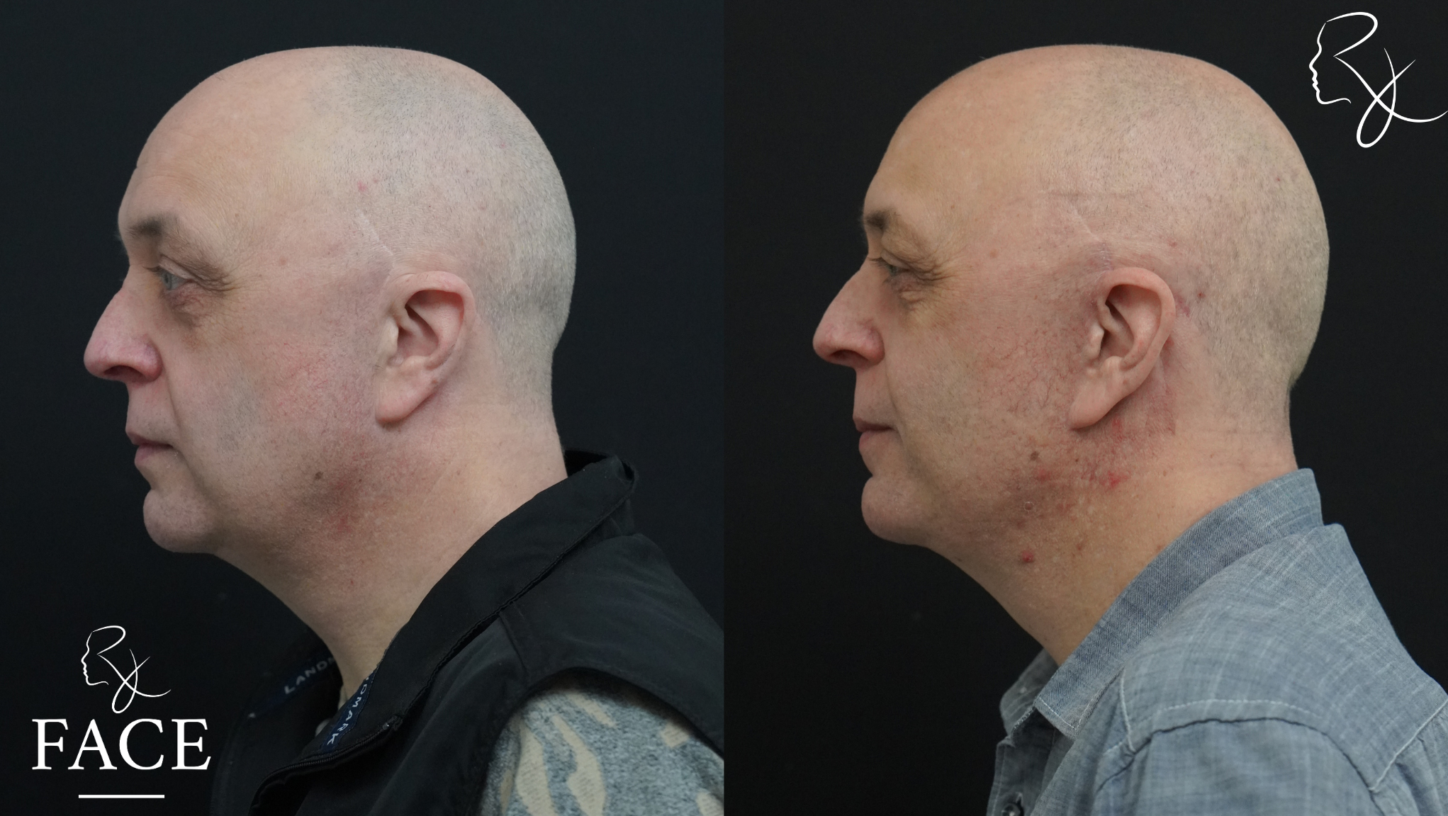 The outcome or results depicted are not
guaranteed and may vary between patients.