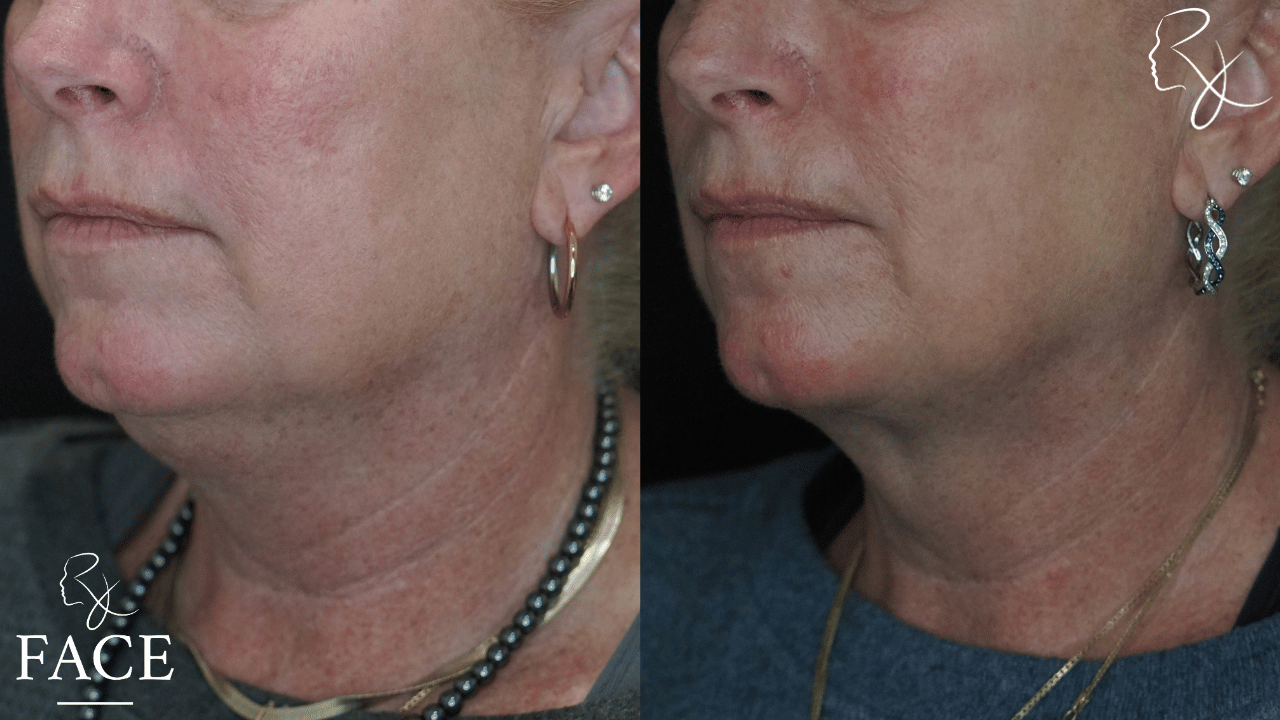 The outcome or results depicted are not
guaranteed and may vary between patients.