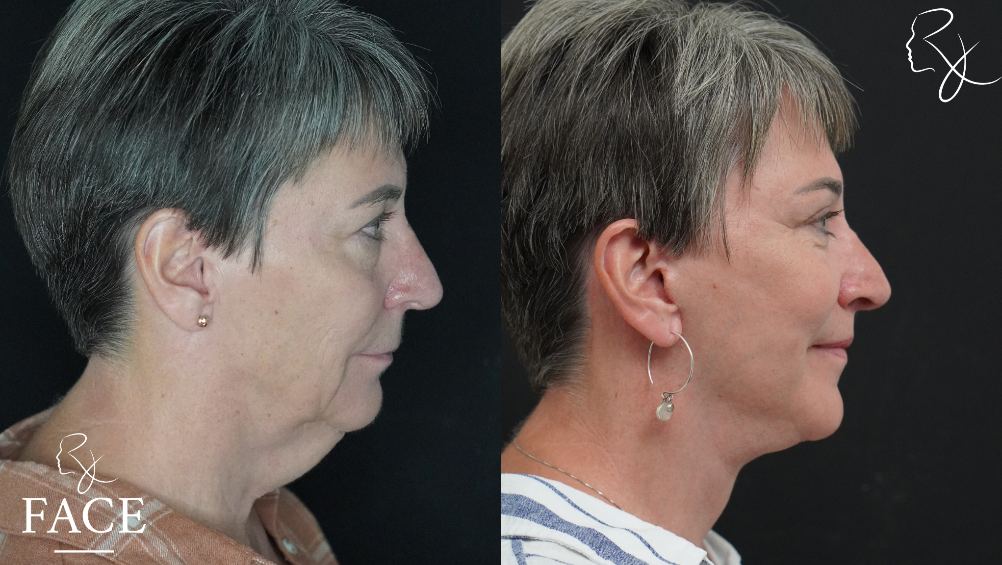The outcome or results depicted are not
guaranteed and may vary between patients.