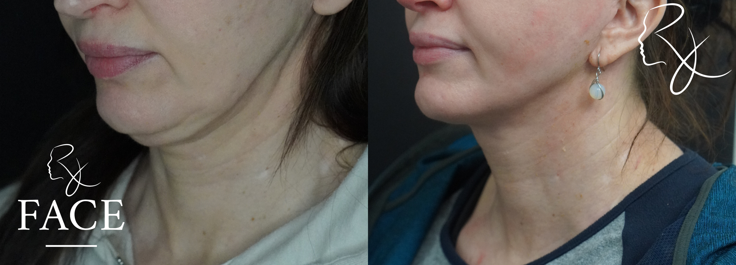 The outcome or results depicted are not 
guaranteed and may vary between patients.