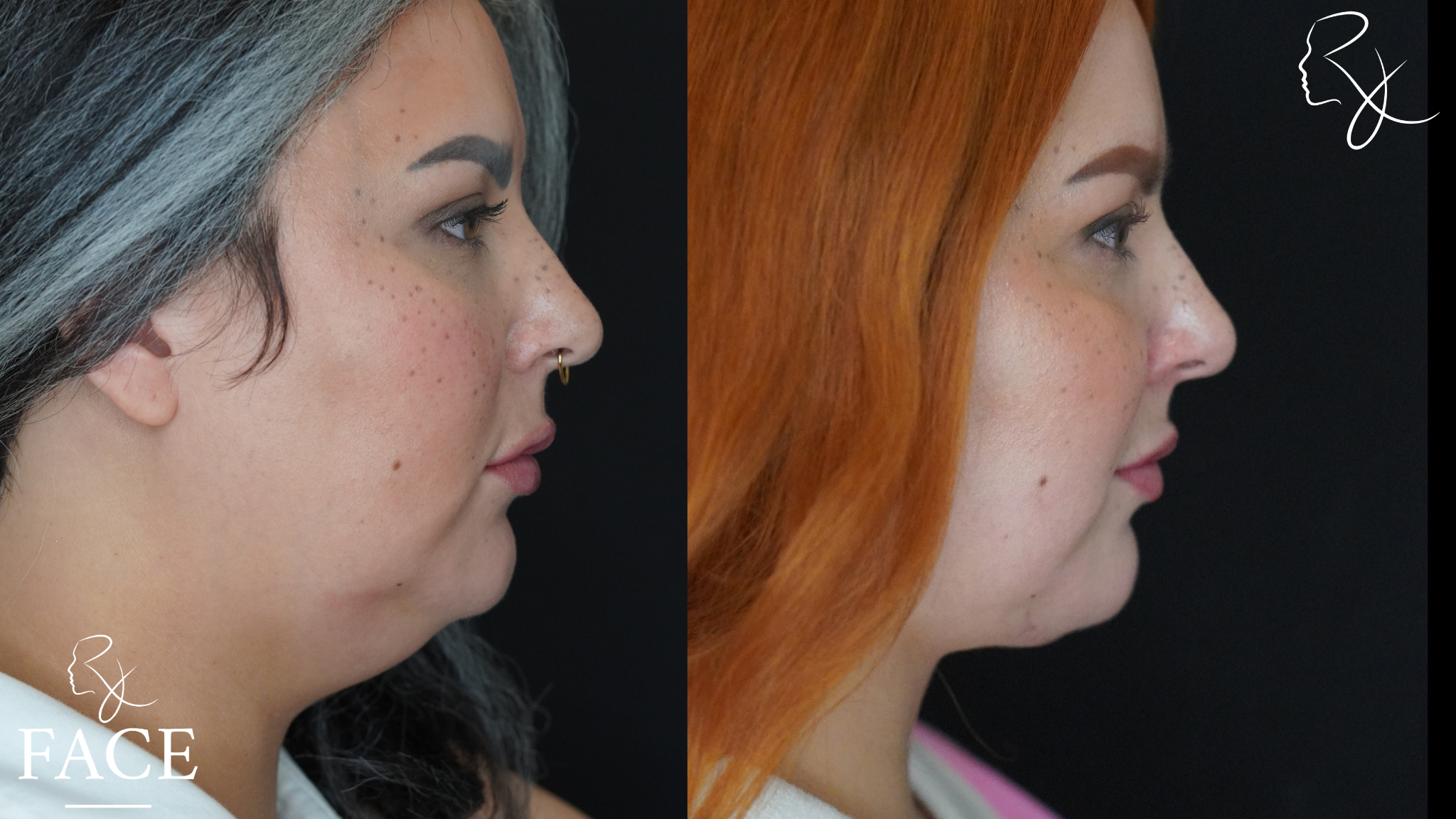 The outcome or results depicted are not
guaranteed and may vary between patients.