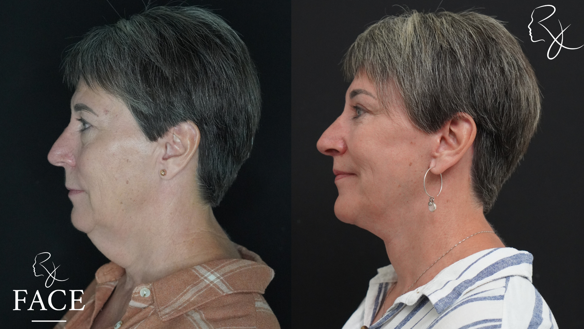 The outcome or results depicted are not
guaranteed and may vary between patients.