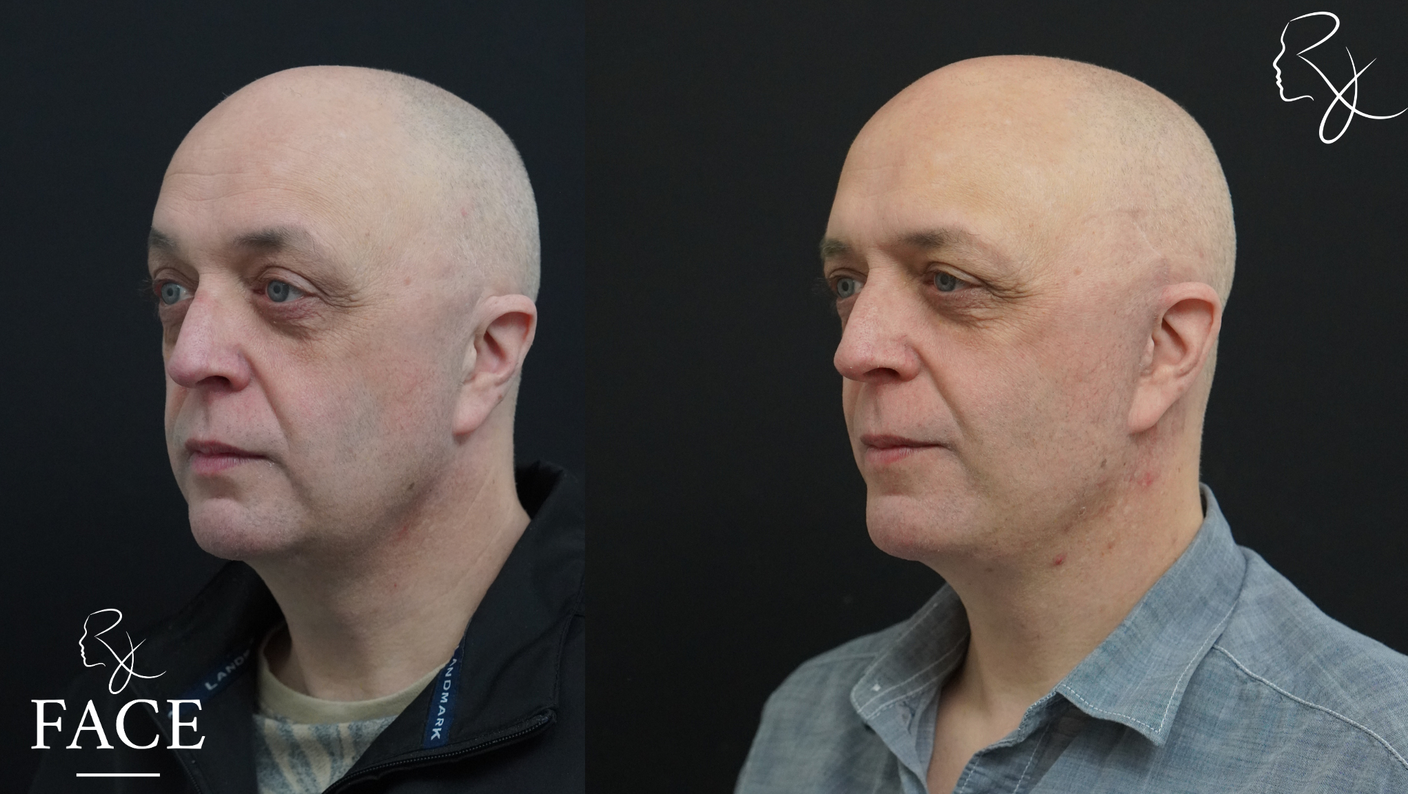 The outcome or results depicted are not
guaranteed and may vary between patients.