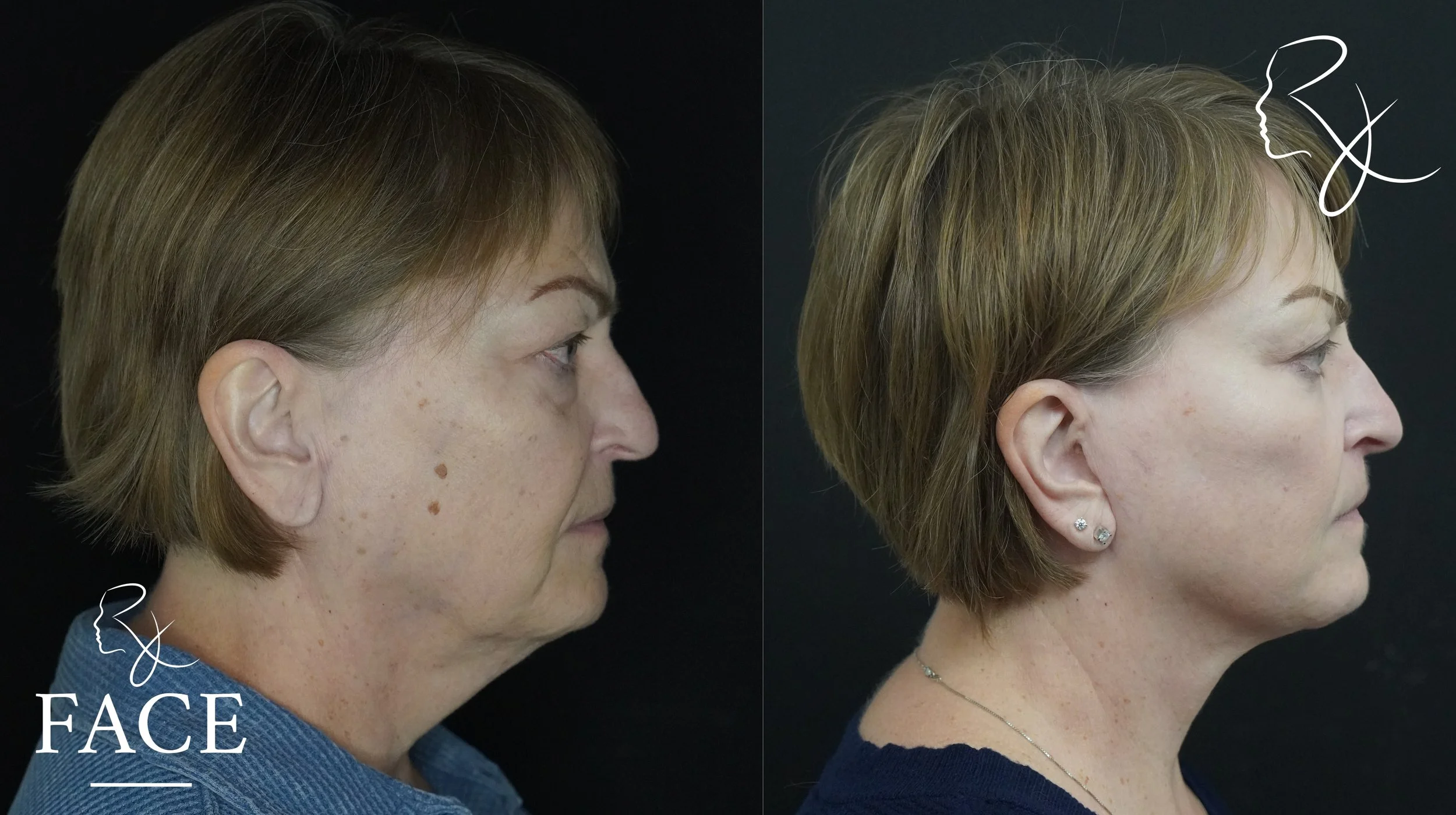 The outcome or results depicted are not 
guaranteed and may vary between patients.