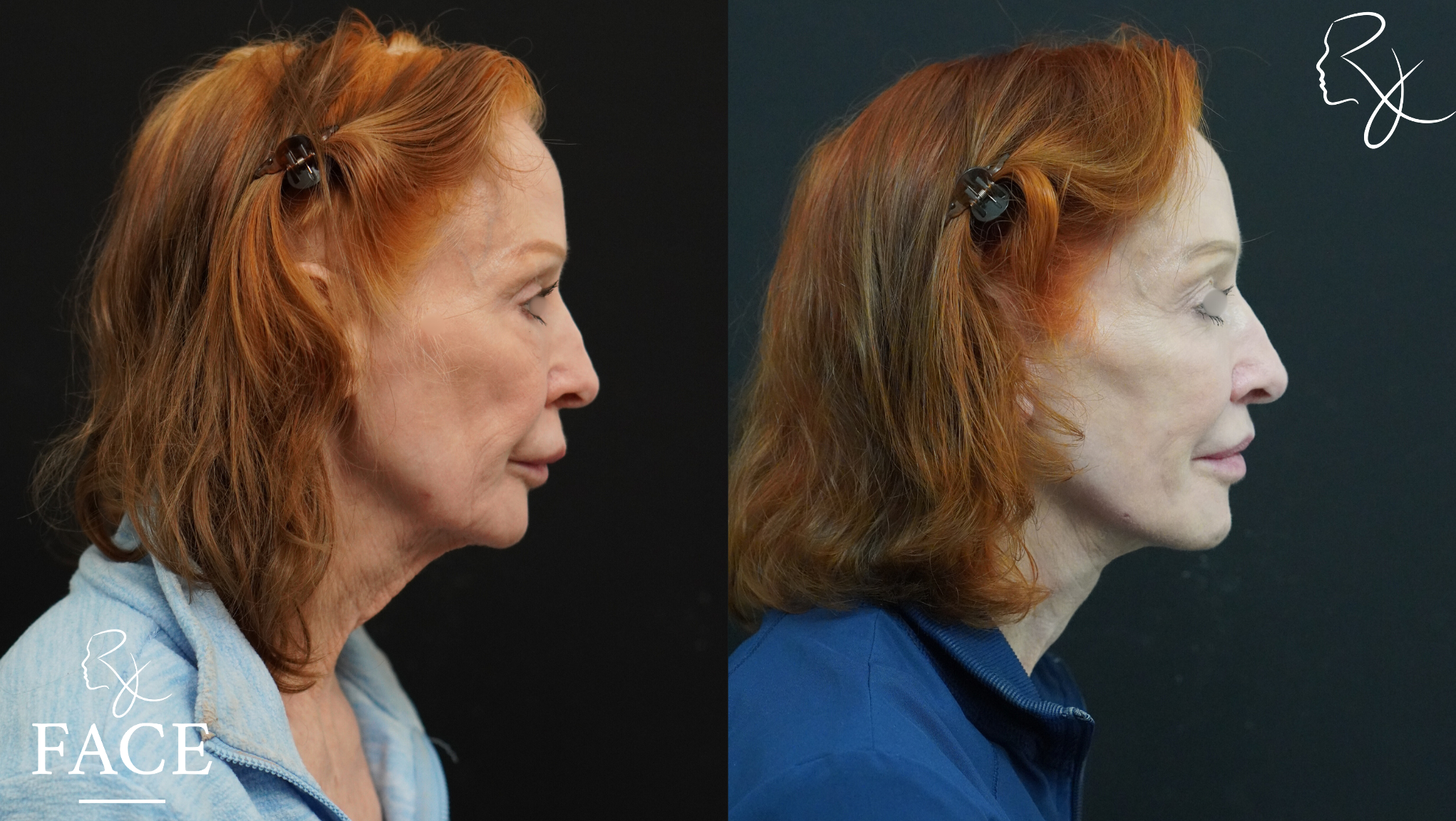 The outcome or results depicted are not
guaranteed and may vary between patients.