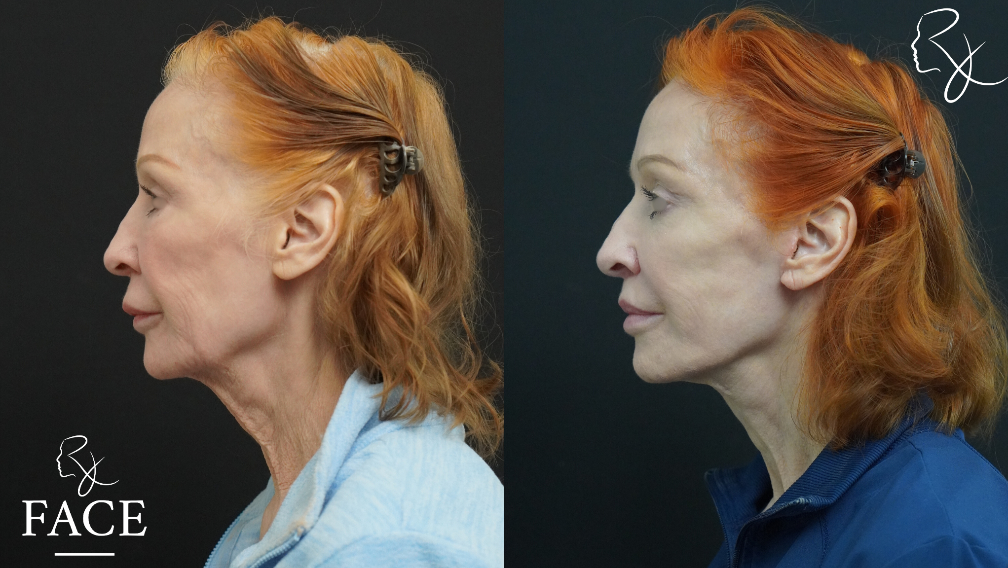 The outcome or results depicted are not
guaranteed and may vary between patients.