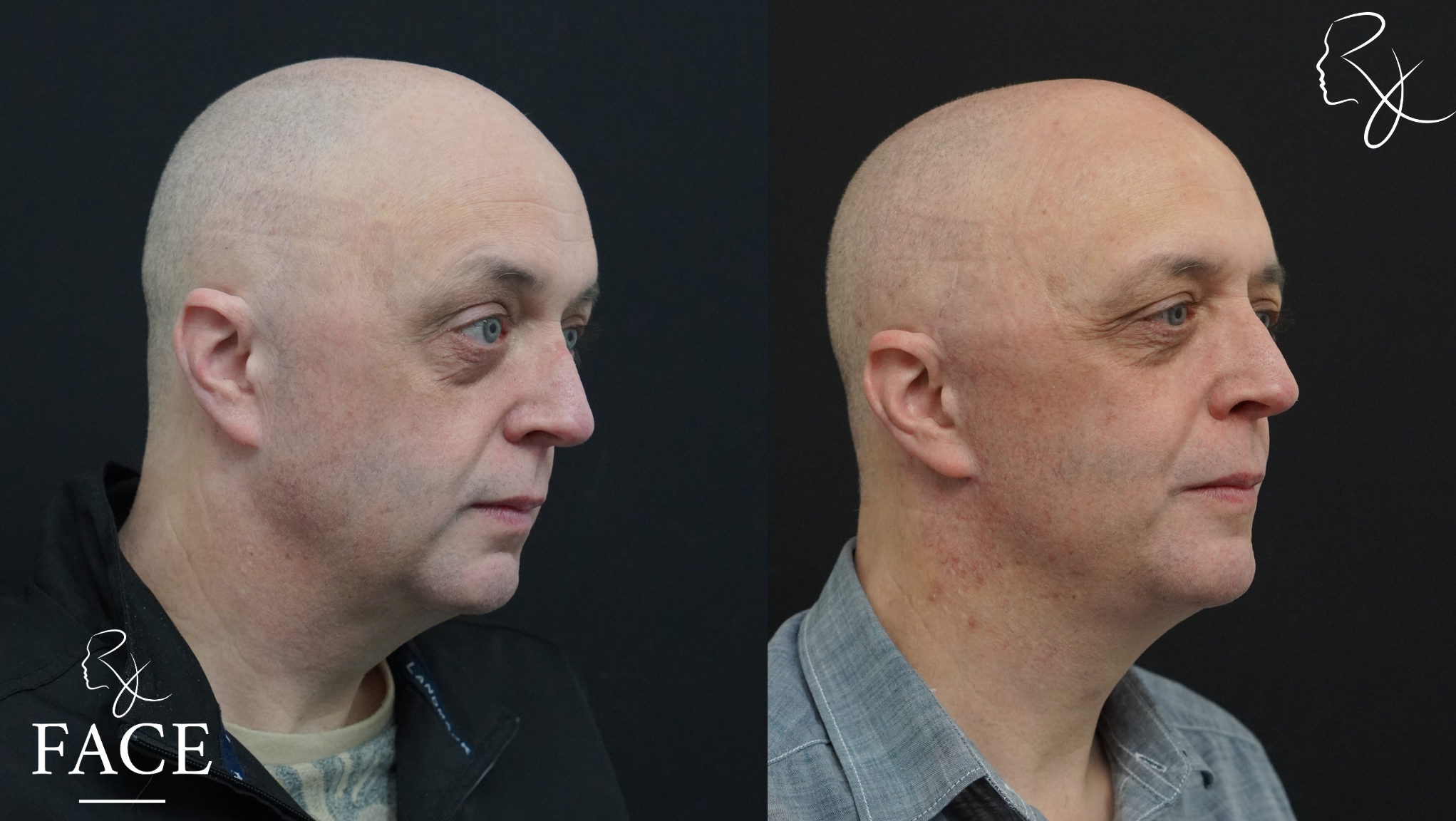 The outcome or results depicted are not
guaranteed and may vary between patients.