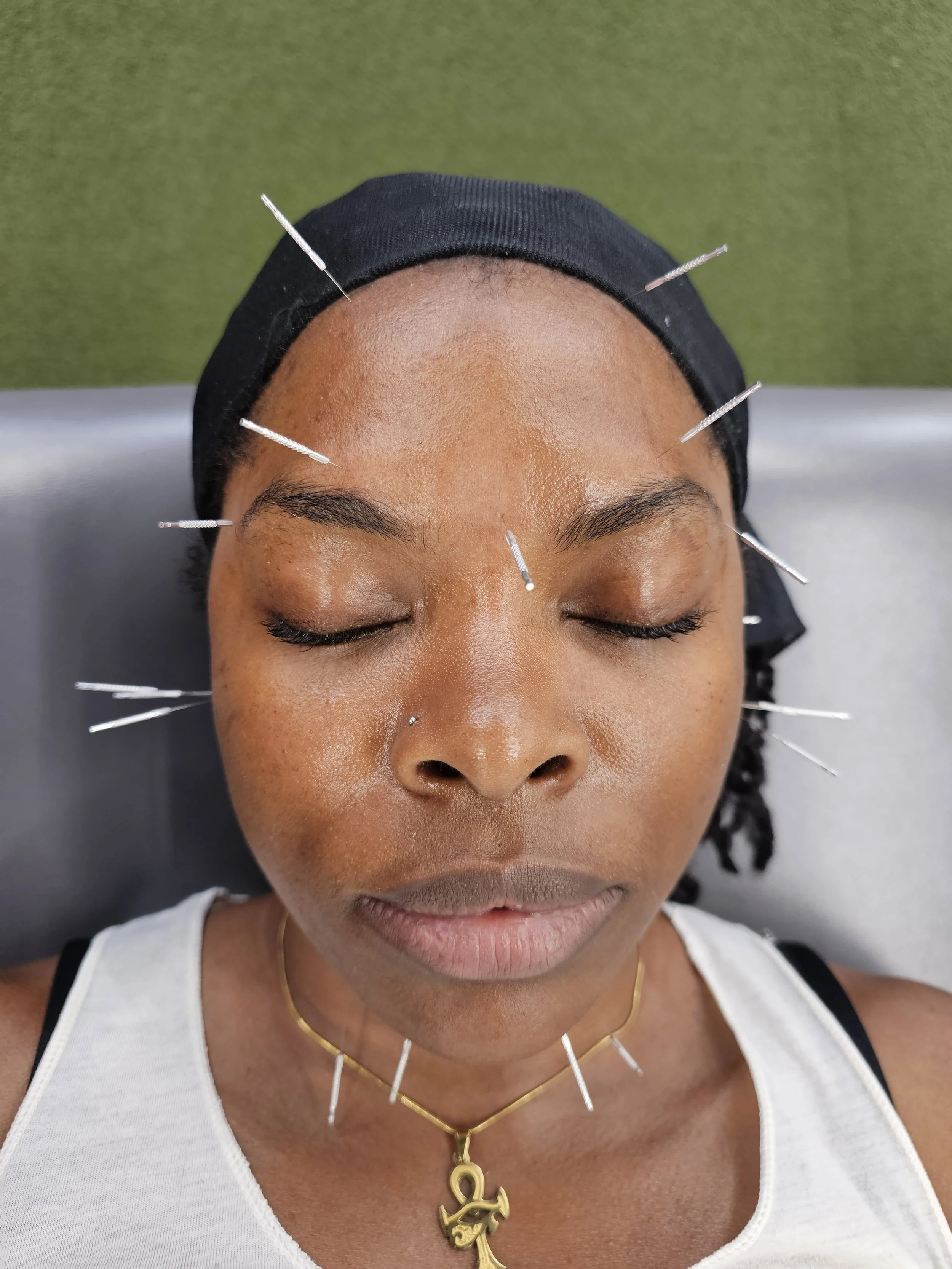 Dry Needling for Headaches and TMJ Pain