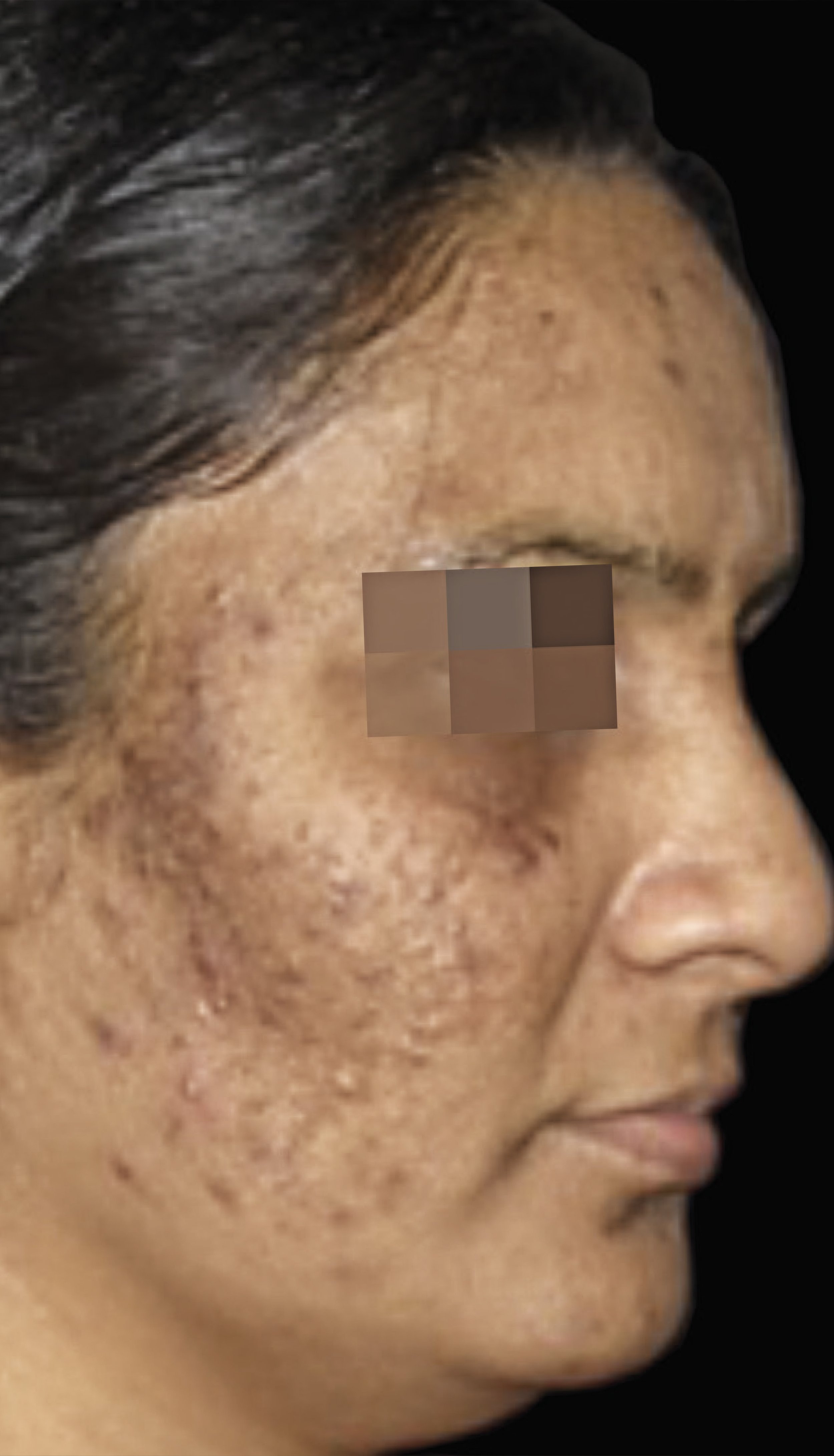 cosmelan case 6 before-300pp.jpg