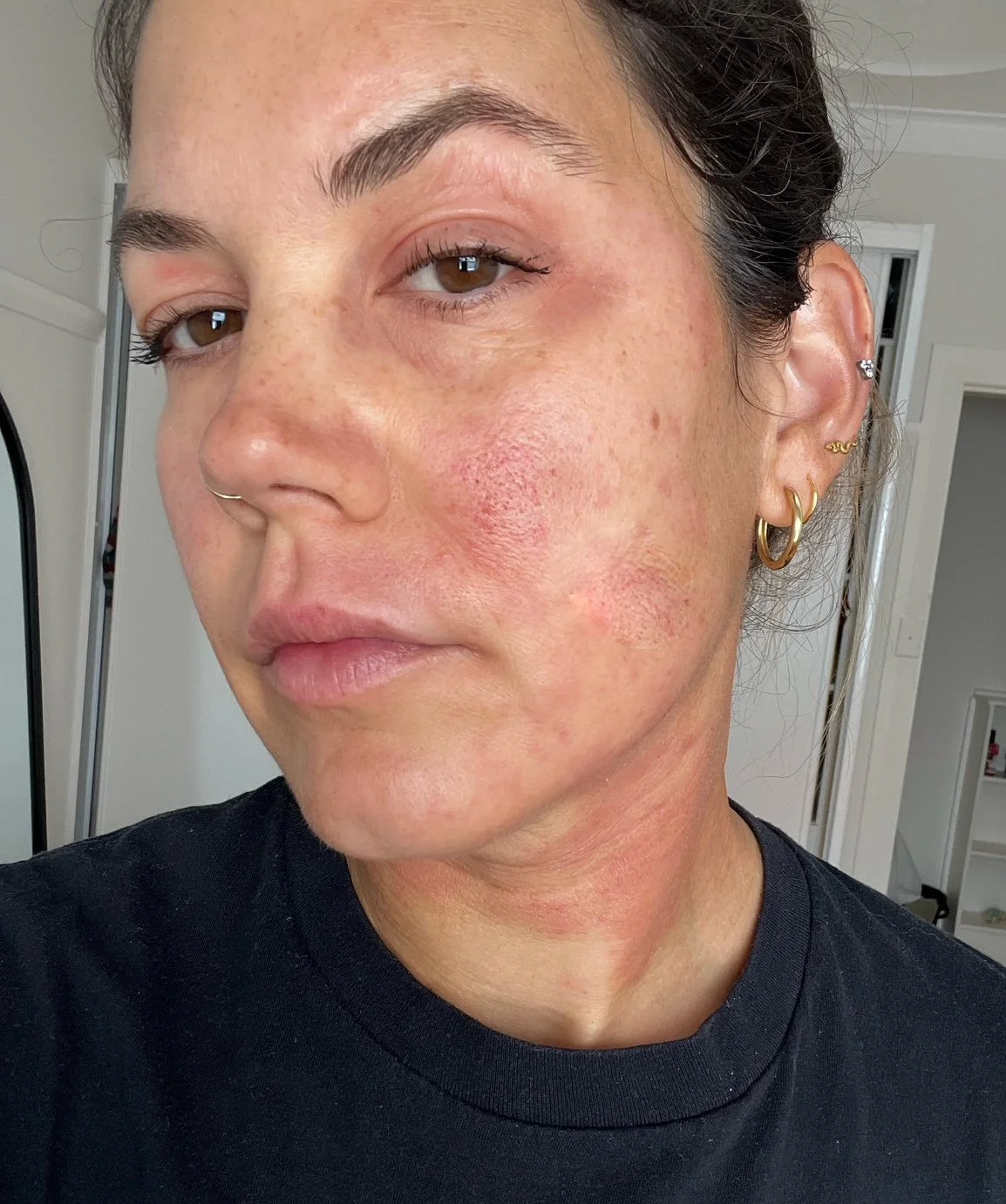 eczema