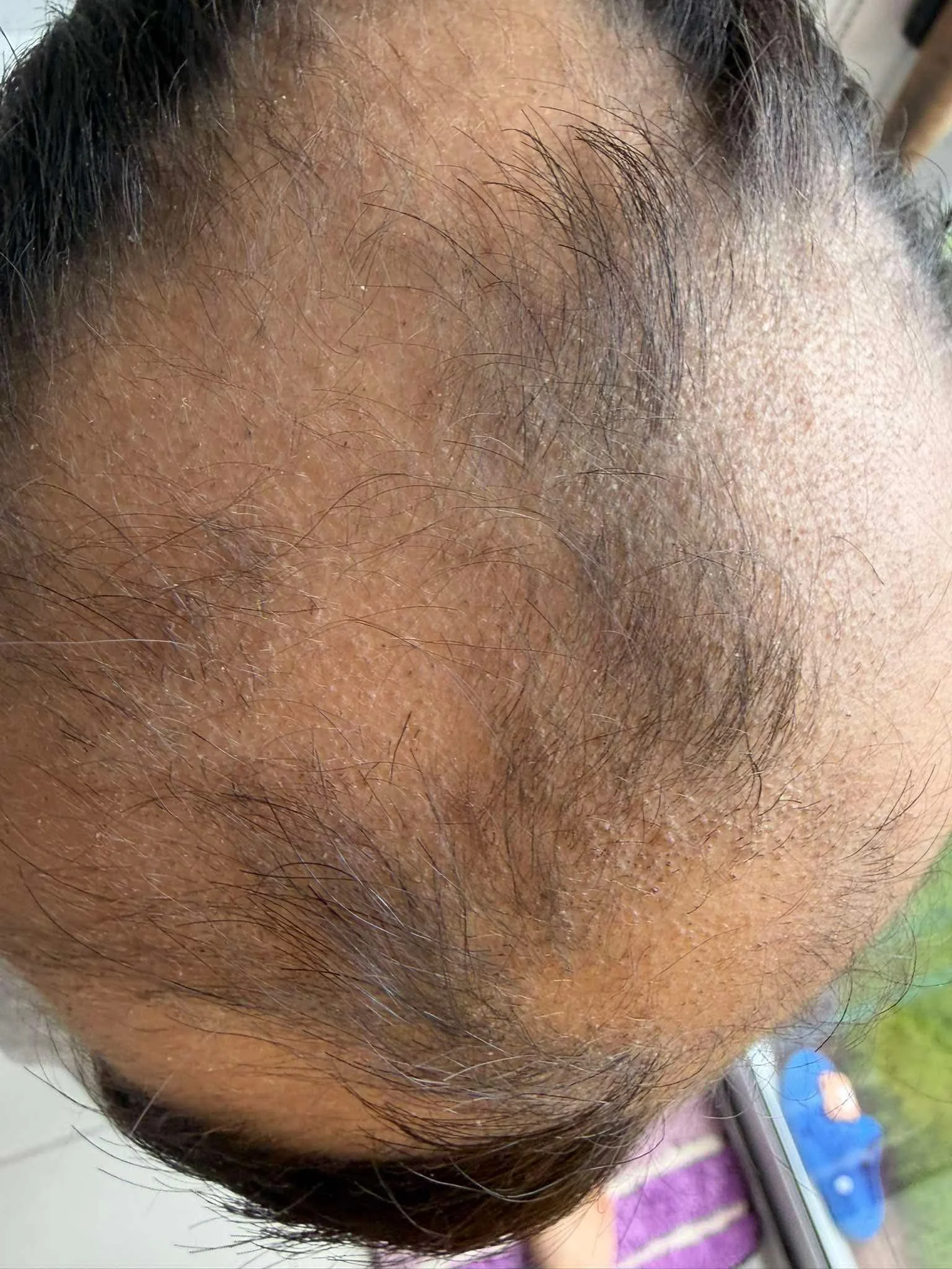Close-up of a person's bald scalp with some hair growing on the sides, viewed from above.