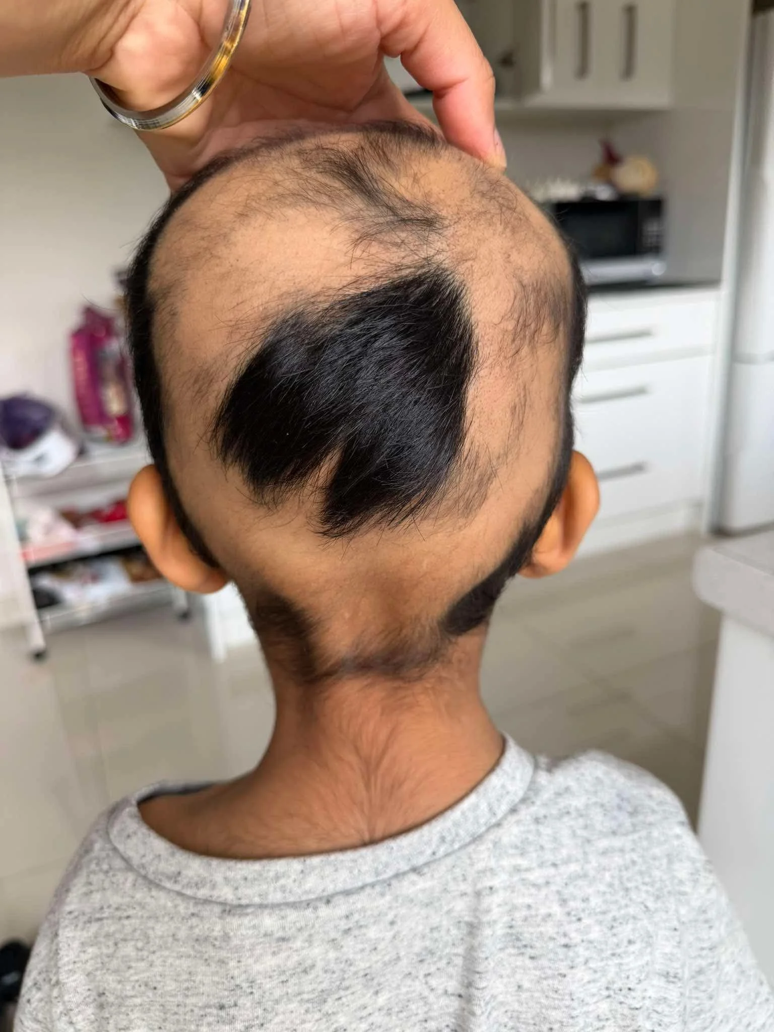Top view of a person's head with a noticeable bald spot and thinning hair, in a kitchen setting.