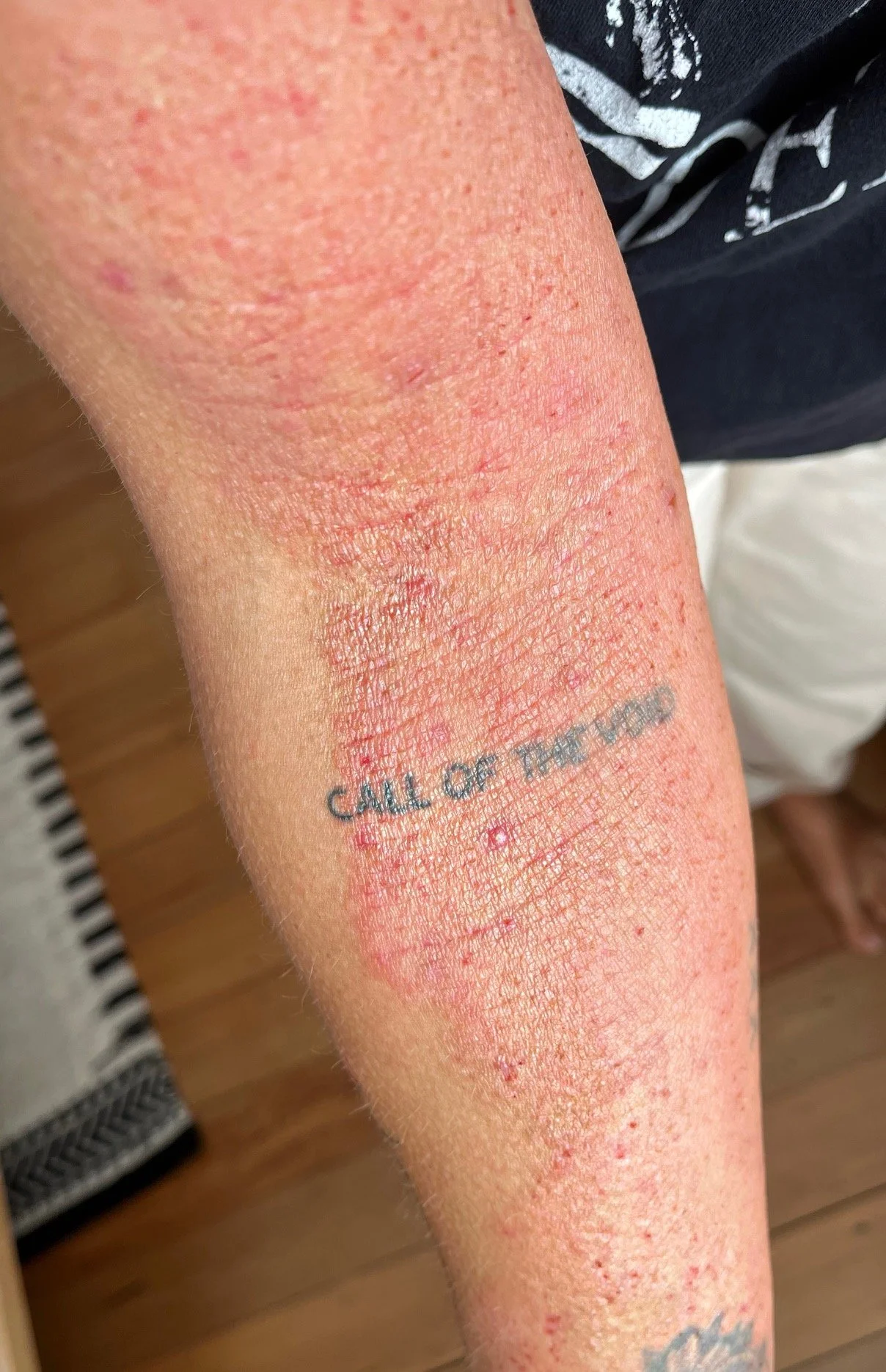 eczema