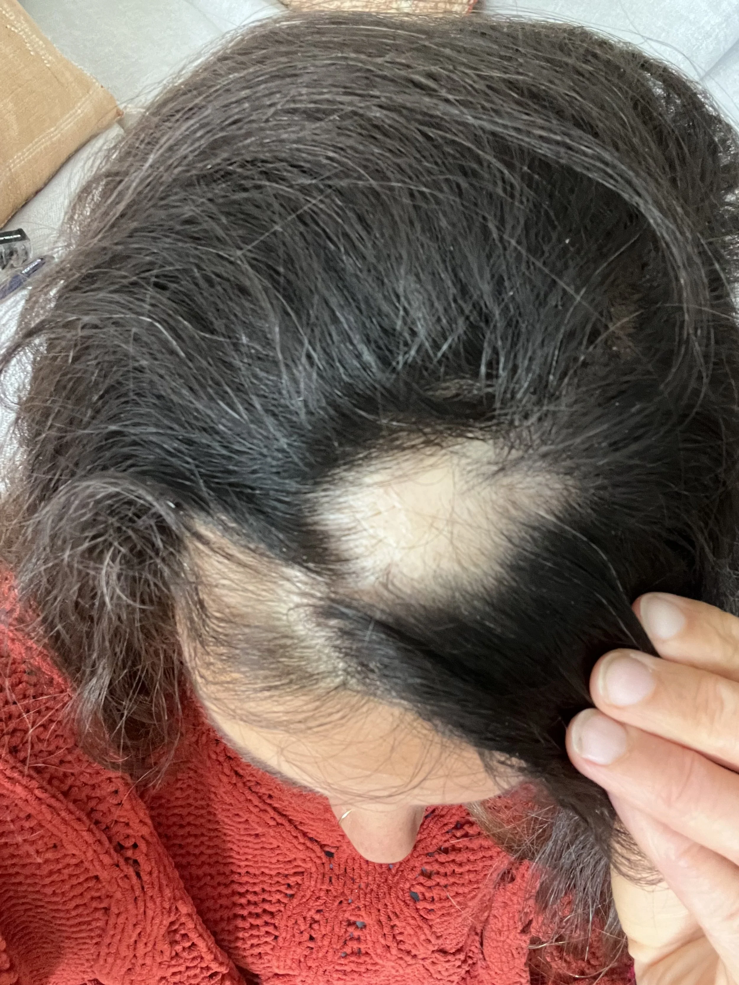 alopecia hair loss