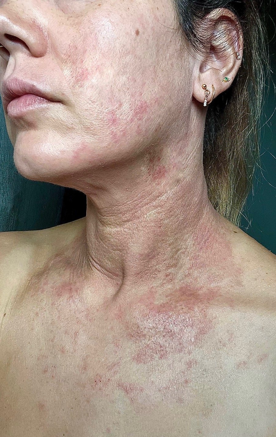 eczema