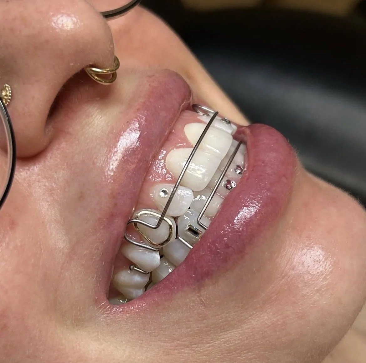 Crystal Tooth Gems + 18k Yellow Gold Full Tooth Faux Cap Tooth Gem (Retainer Friendly)
