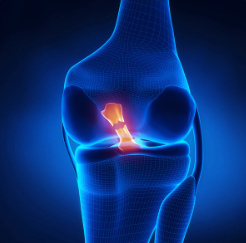 Choosing the Right ACL Graft: Patella, Quadriceps, and Hamstring Options