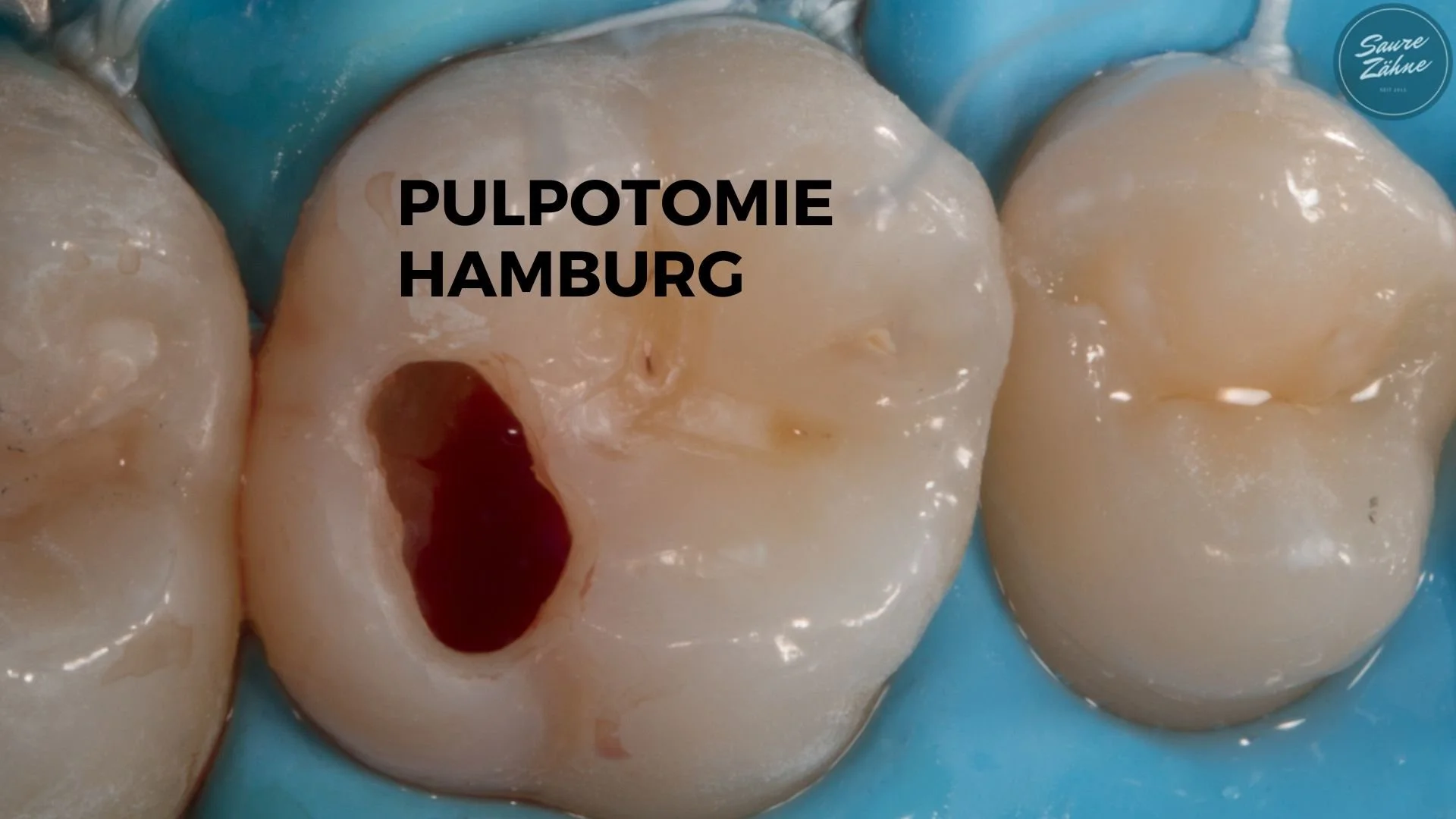 Pulpotomie Workshop Hamburg