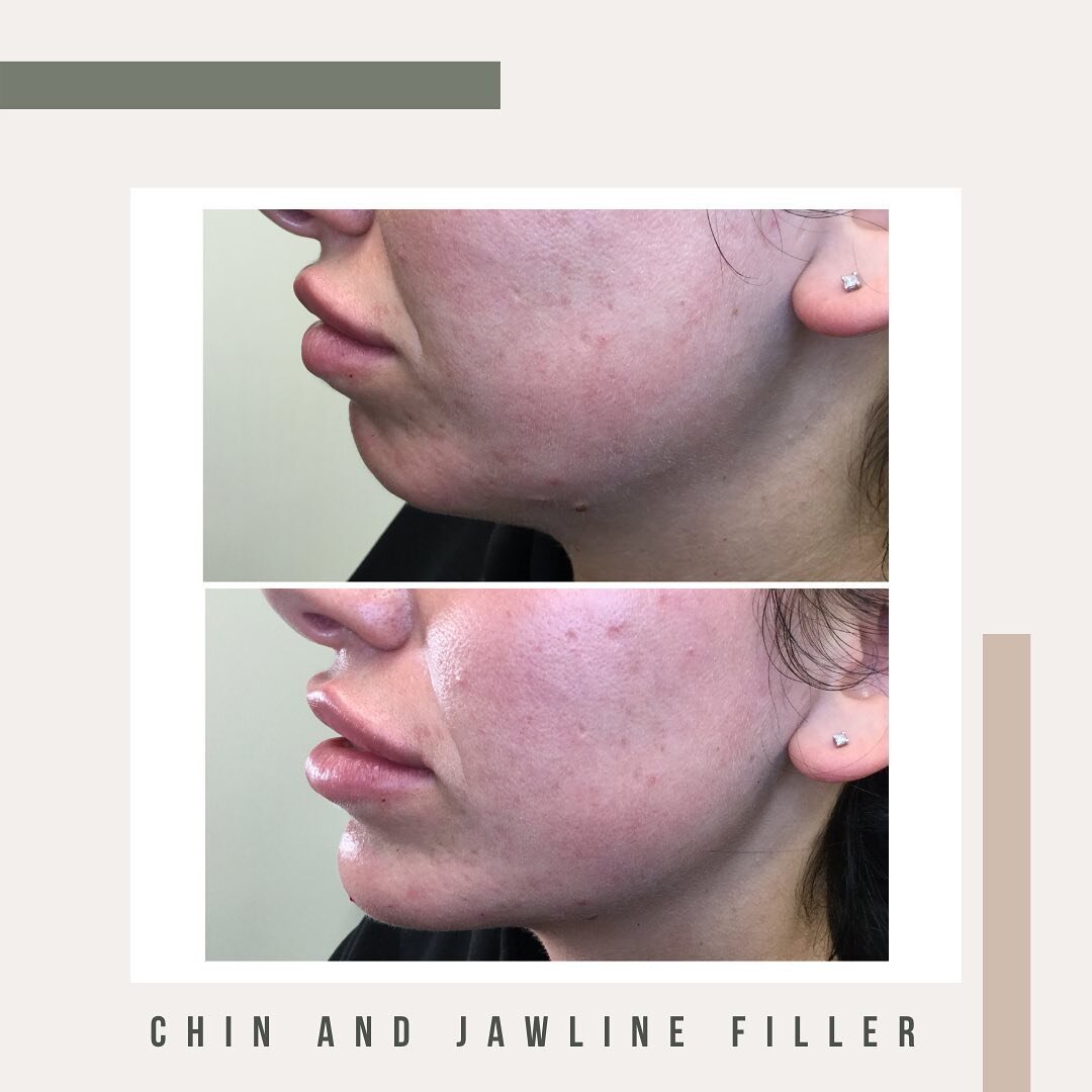 Profile Balancing with chin and jawline filler
**Before and After**
💉Treatment: Chin, jaw line
💧Product: Dermal filler
👩&zwj;⚕Injector: Jennifer Danielsen MN NP
🗓Longevity: 12-18 months
💰Investment: $550/syringe
🩹Recovery: Two weeks with a touc