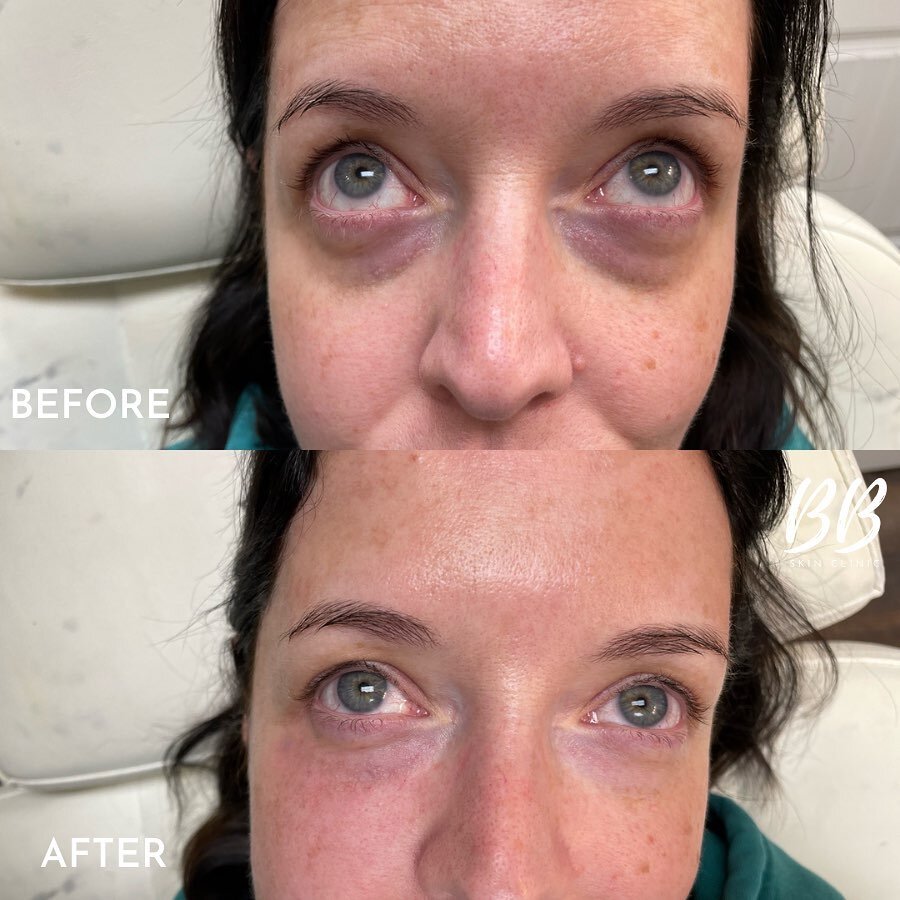 As a following up to the that last post! @injectorsheilarn be proud! This post is here for two reasons 1) to show that tear trough filler can be a game changer in the right candidate. That&rsquo;s right not everyone is a candidate for tear trough fil