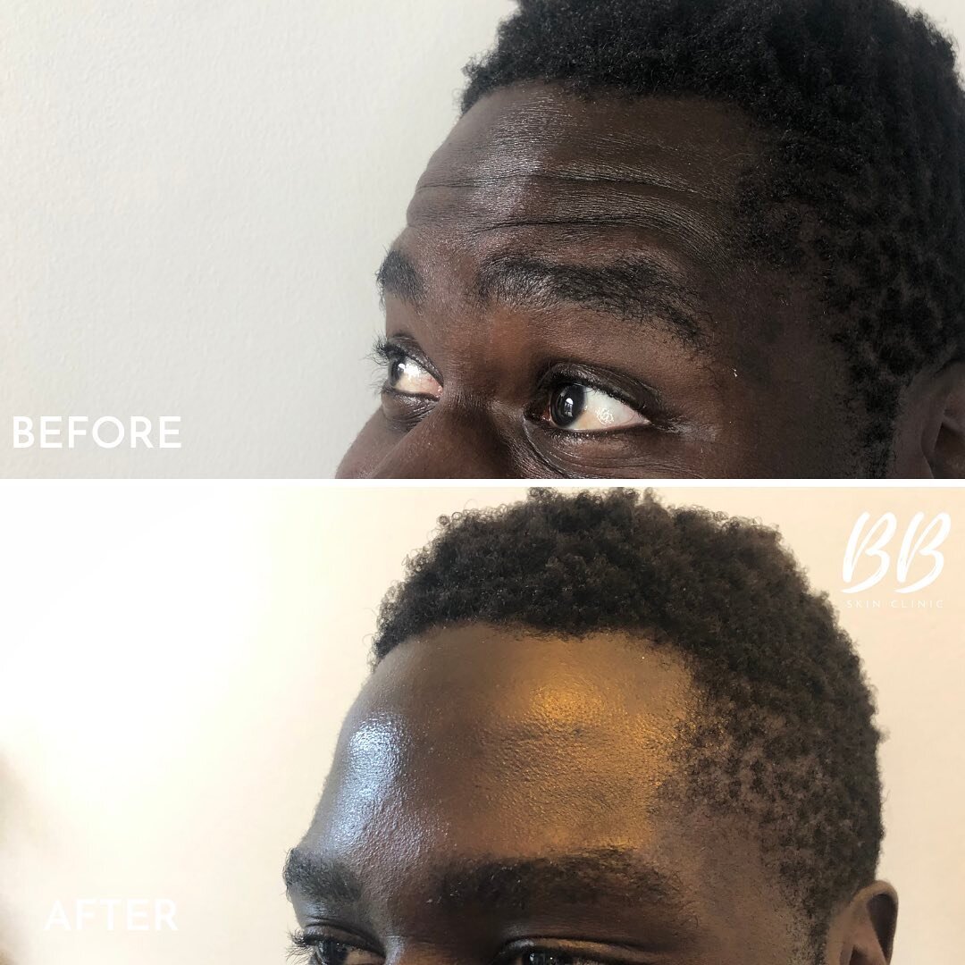 Brotox- it is more common than you would think!
*
**Before and After**
💉Treatment: Glabella and forehead lines
💧Product: Dysport
👩&zwj;⚕Injector: Jennifer Danielsen MN NP
🗓Longevity: 3-5 months
💰Investment: $10/unit
🩹Recovery: Two weeks for ful