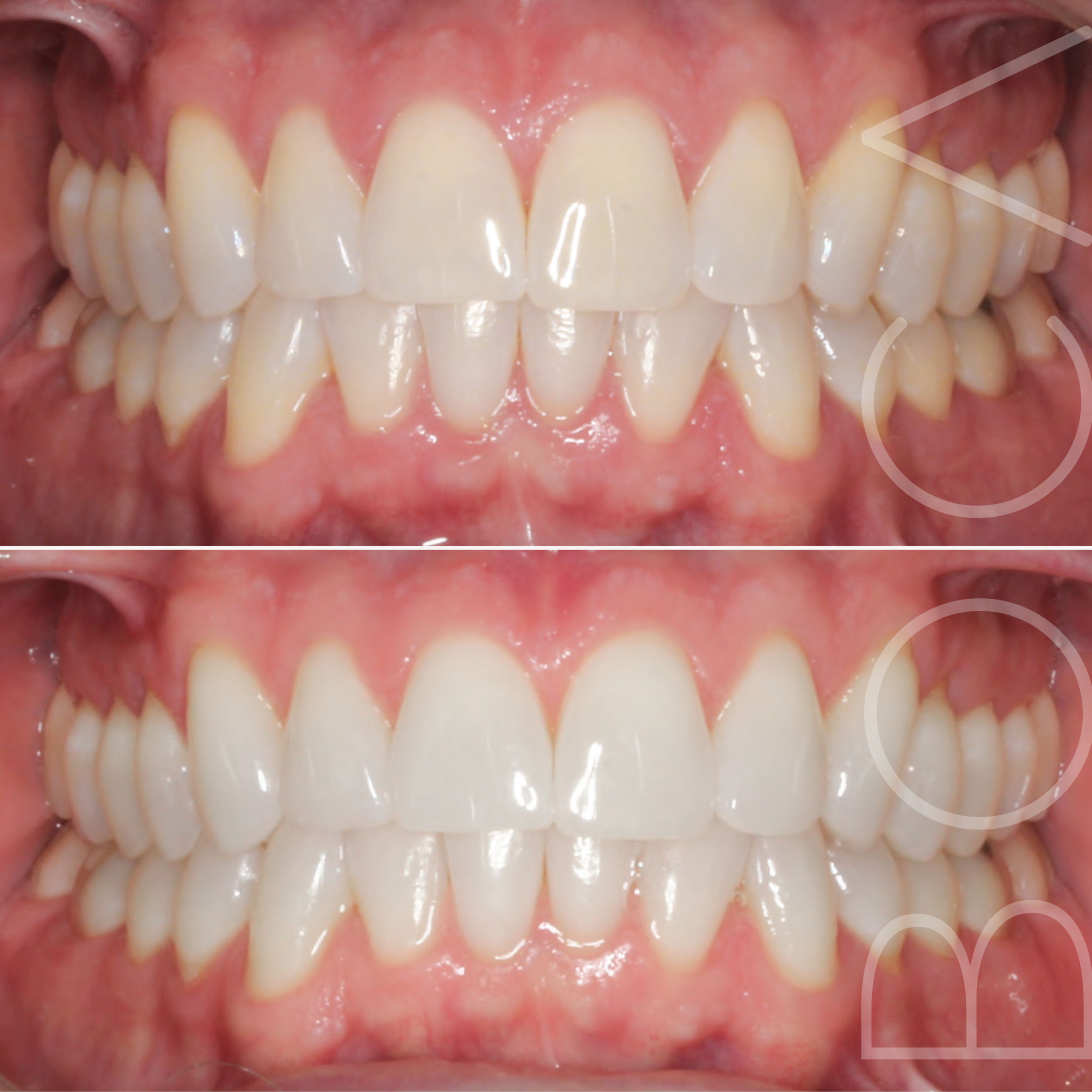 GENTLE, GLOW UP TEETH WHITENING