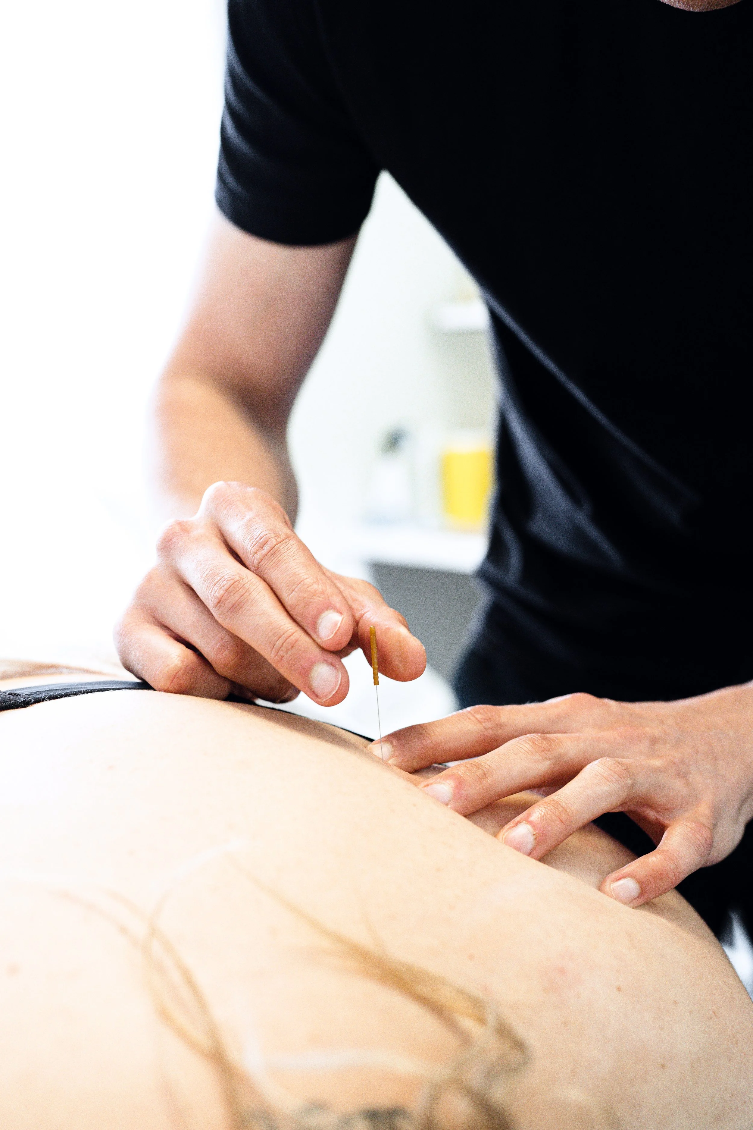 Dry needling treatment at Adelaide Physiocare Adelaide