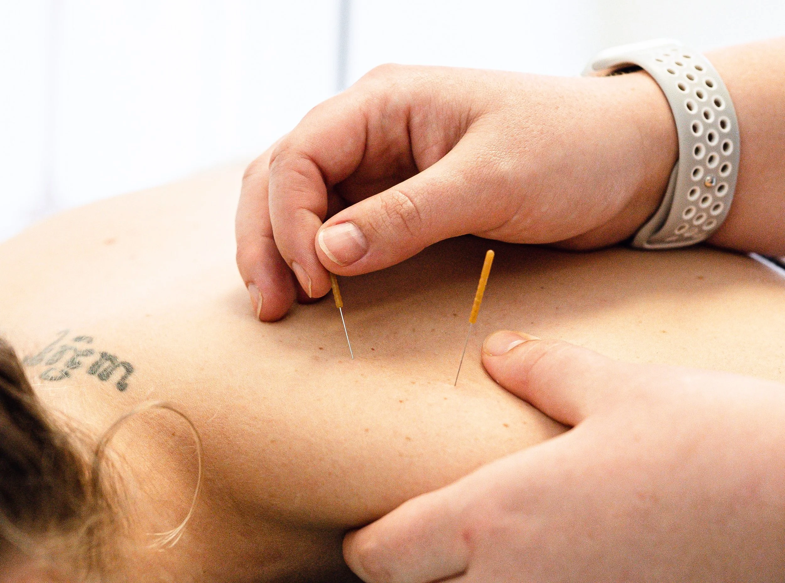 The Adelaide Athlete’s Guide to Recovery: Sports Acupuncture vs. Dry Needling
