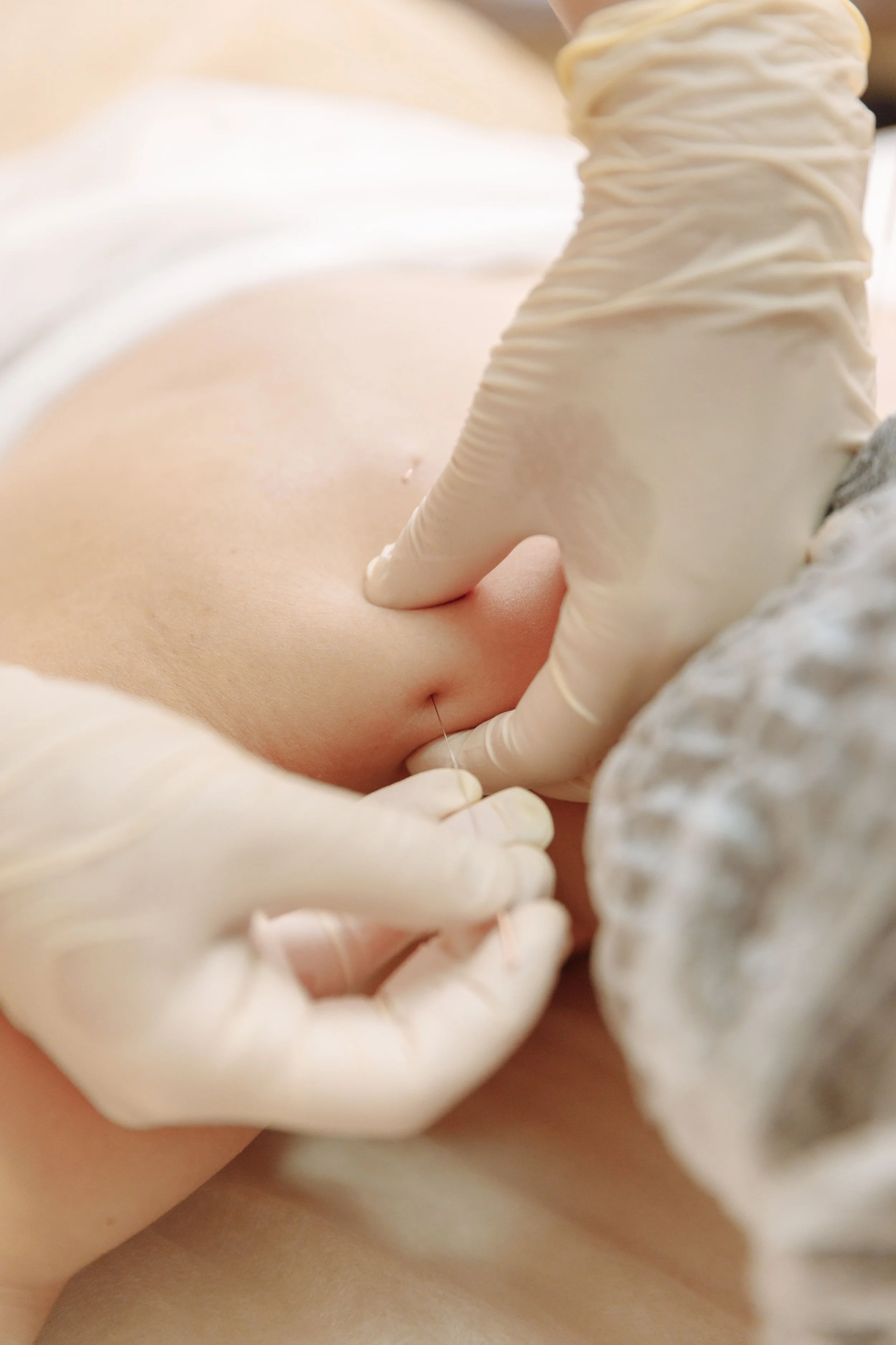 The Secret to Faster Recovery: Why Dry Needling is a Game-Changer for Muscle Pain