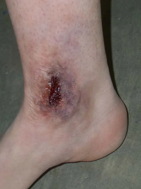 gash on foot.jpg