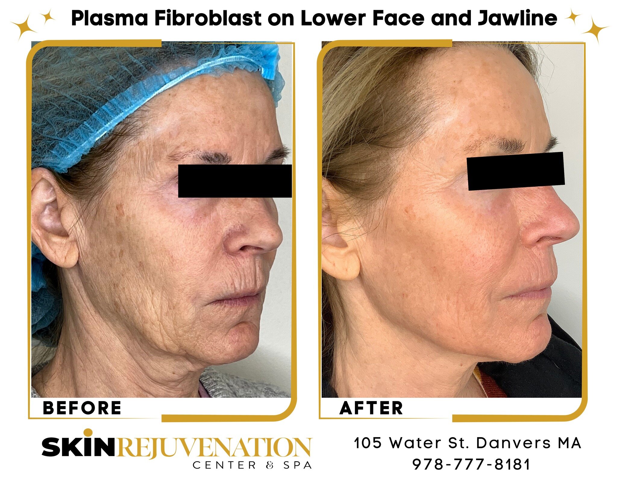 These Before and After Plasma Fibroblast Photos are just incredible! Our Master Plasmologist, Saundra, treated our client's lower face and jawline. The results are REAL and undeniable. No Editing or Photoshop!! If you want to turn back time with plas
