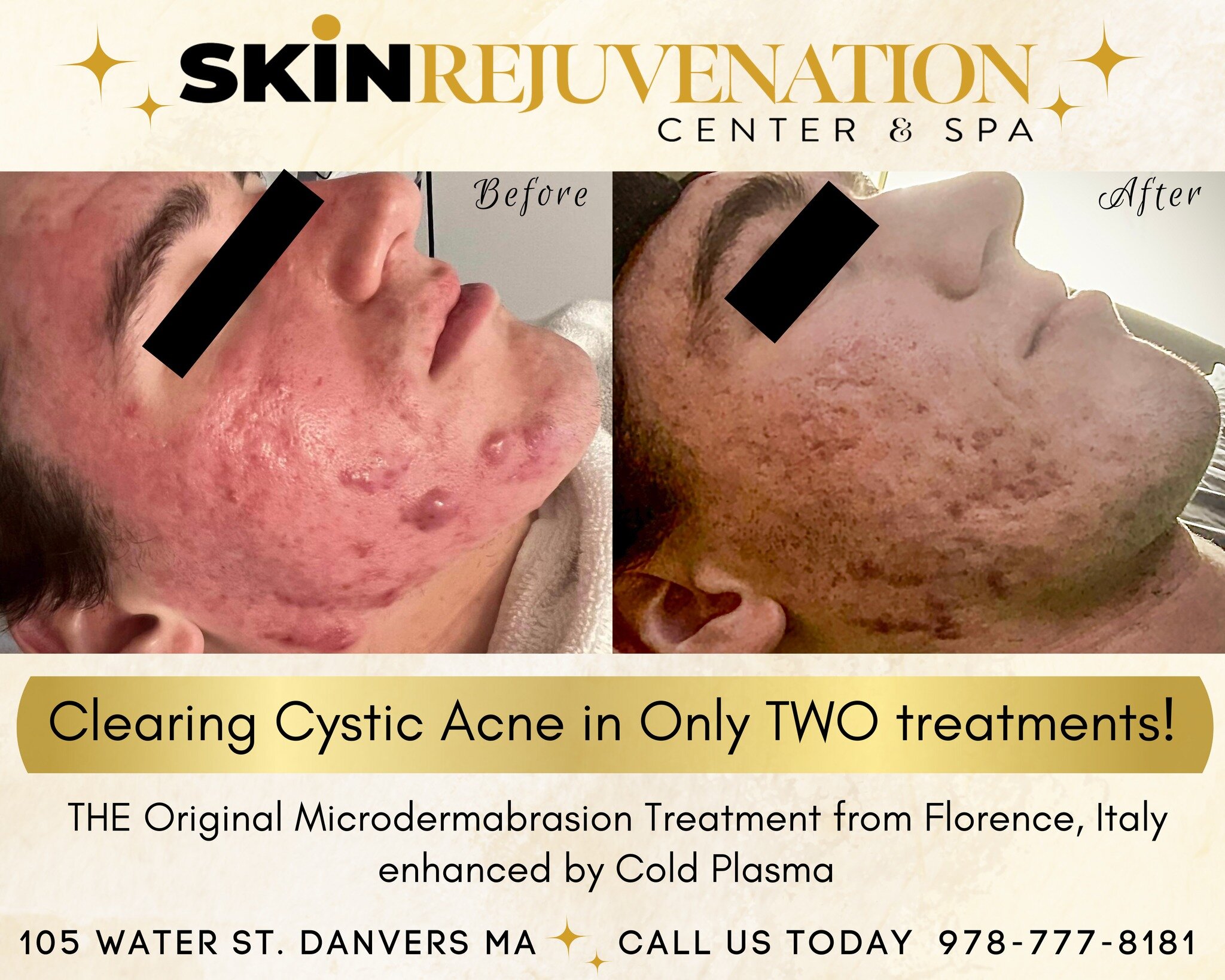 Are you struggling with Acne? Do you hate the texture of your skin? Do you have enlarged pores or acne scars?

Call now for your complimentary consultation! 978-777-8181

#skincare #skinrejuvenationcenter #medicalspa #healthyskin #skincaretips #skint