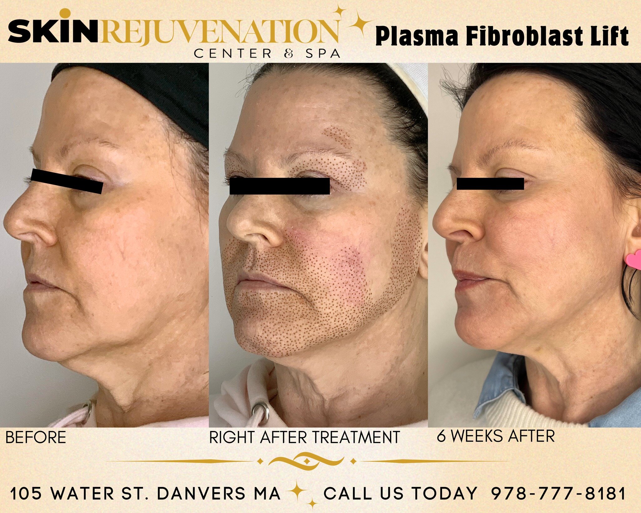 This beautiful client had AMAZING results with Our Revolutionary Plasma Fibroblast Lift Treatment. She will continue to see improvements in her skin for another 2-4 months. The results last YEARS! 

Forget about surgery! Plasma Fibroblast is non-surg