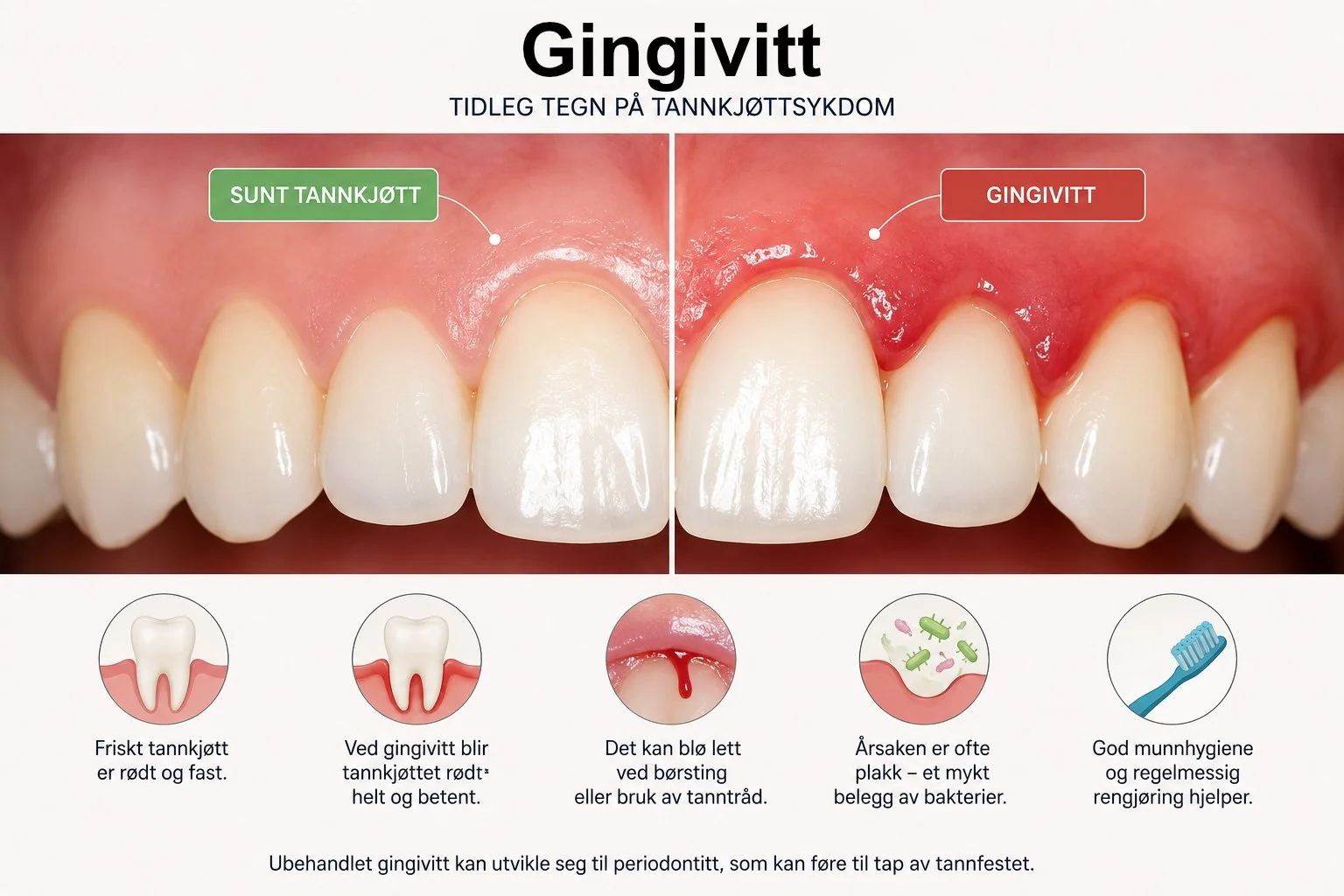 gingivitt
