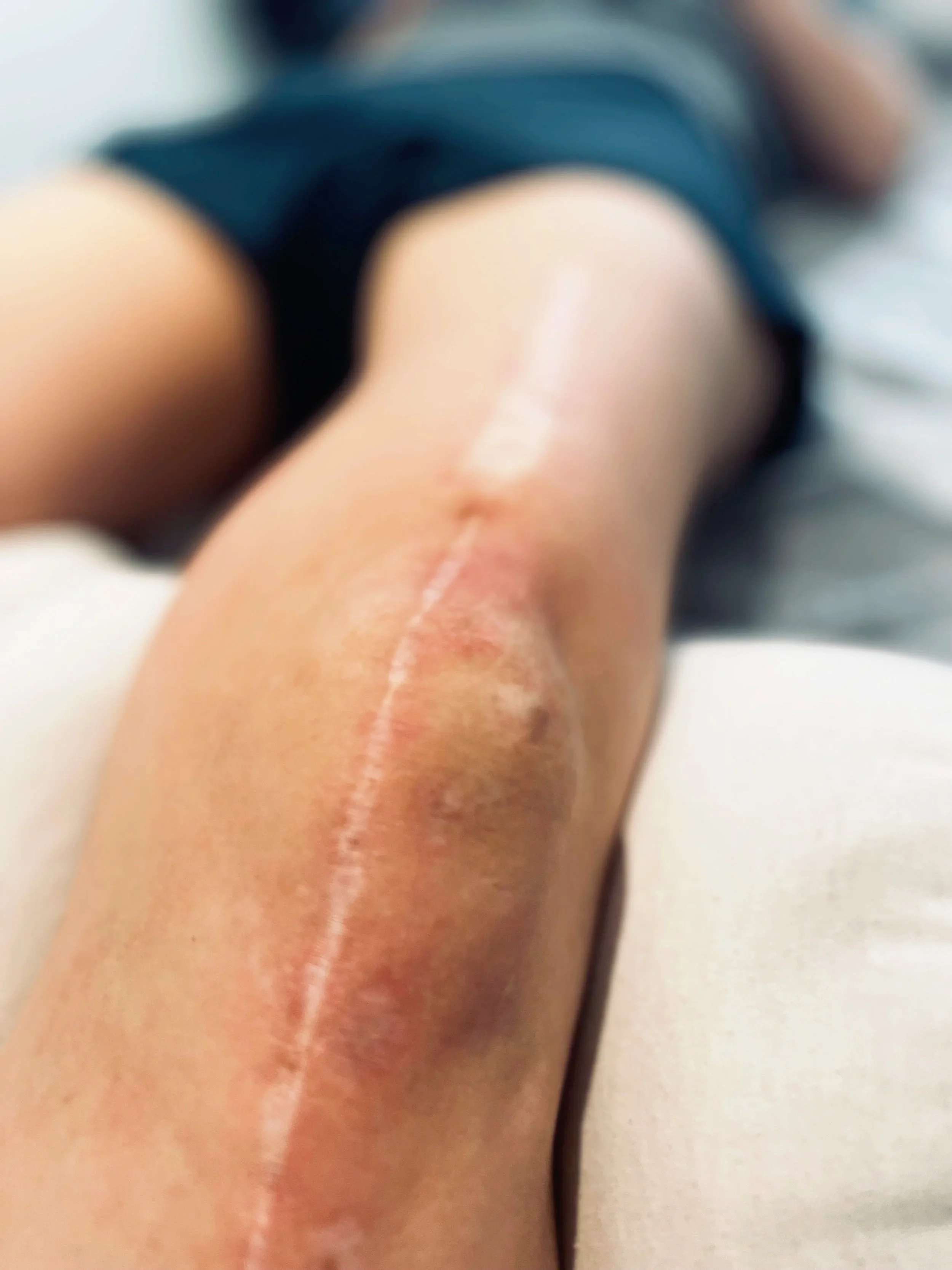 Traiter les cicatrices en ostéopathie : pourquoi c’est essentiel pour le corps