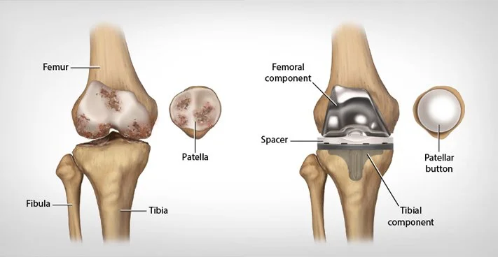 Knee Replacement, Photoshop, 2016.