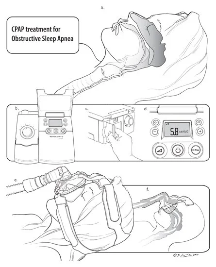 Continuous Positive Airway Pressure Device, Illustrator, 2010.