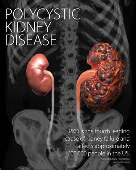 Polycystic Kidney Disease, 3dsMax and Photoshop, 2010.
