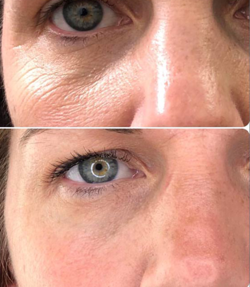 plasma pero pred a po.PNG