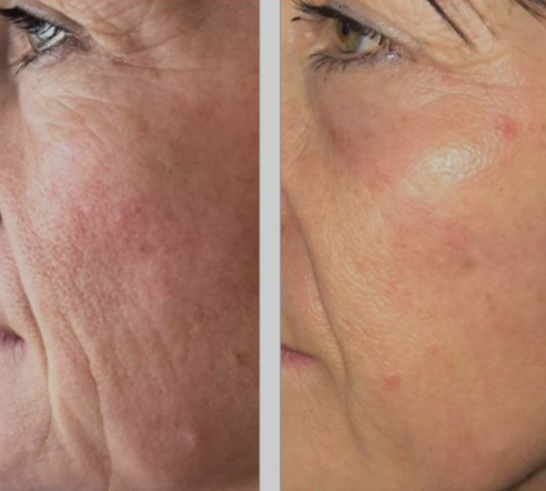 plasma pred a po nasolabiálna ryha.PNG