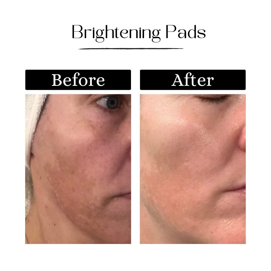 Get ready to glow! Check out this amazing before and after from our antioxidant brightening pads! Call today to get your hands on this fantastic product!
.
.
#CarrollCosmeticClub #CosmeticCareCarrollton #TrustedCosmeticProvider #AdvancedCosmeticCare 
