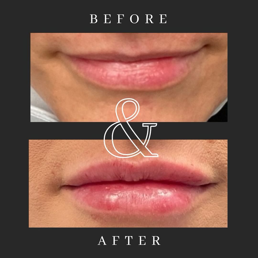Transforming pouts, one stunning smile at a time! Say goodbye to thin lips and hello to plump perfection! 💄💖 #LipTransformation
.
.
#CarrollCosmeticClub #CosmeticCareCarrollton #TrustedCosmeticProvider #AdvancedCosmeticCare #WestGeorgiaCosmetics #C