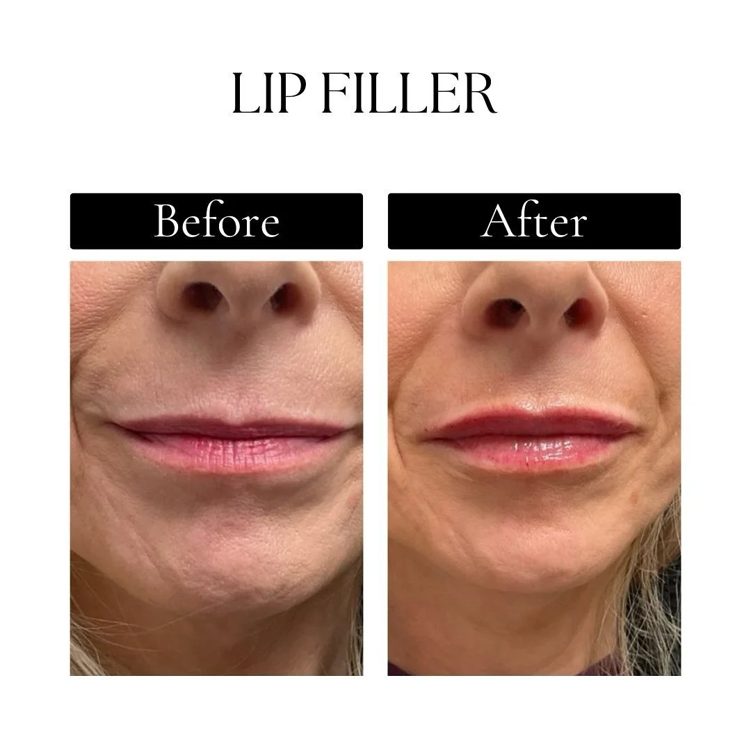 Check out this stunning lip filler transformation! If you’re aiming for a natural, subtle enhancement, you’ve come to the right place. We take the time to understand your unique needs and deliver results tailored just for you—whethe