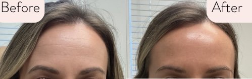 "These ladies are amazing!!!! I am doing the laser hair removal, but I am also thrilled to have gotten my first Botox treatment on my forehead. It is wonderful! I feel so refreshed!" -Dani