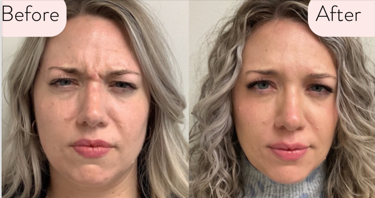 "I am so happy to have found Carroll Cosmetic Club. Scheduling is easy. Everyone is incredibly kind and professional. I am always impressed with the results and will continue to use them for my cosmetic needs." -Heather