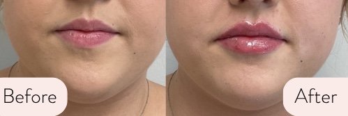 "There are not enough good things to say about the team at Carroll Cosmetic Club! They go above and beyond to make you feel welcomed and take time explaining the service you’re receiving. I got lip filler and absolutely love my results!" -Lauren
