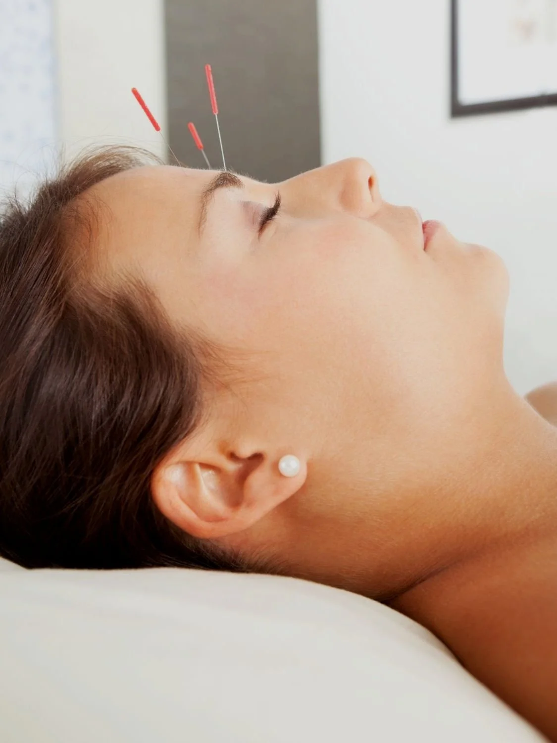 Acupuncture & Chinese Medicine Clinic Auckland NZ — Integrative Acupuncture