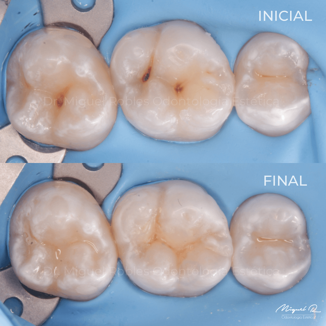 Restauración de Dientes con Resina en Polanco CDMX.png
